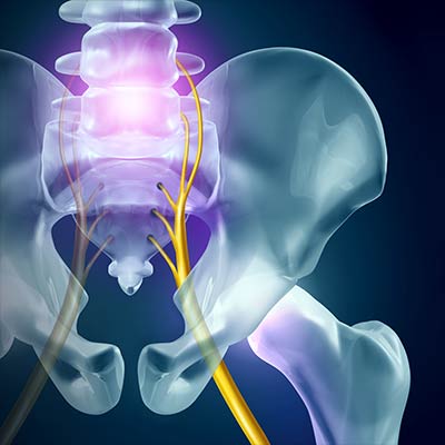 The chiropractor in Irvine uses targeted spinal adjustments to help patients overcome sciatica and restore mobility.