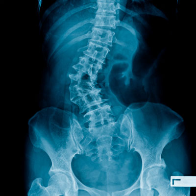 Scoliosis in Adults
